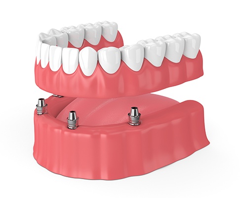 Illustration of implant dentures in Southlake, TX