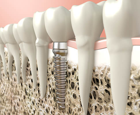 Digital illustration of a dental implant