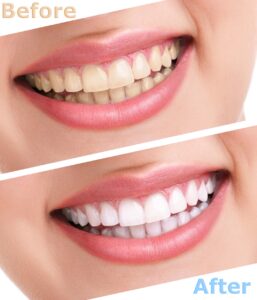 Before and after teeth whitening results